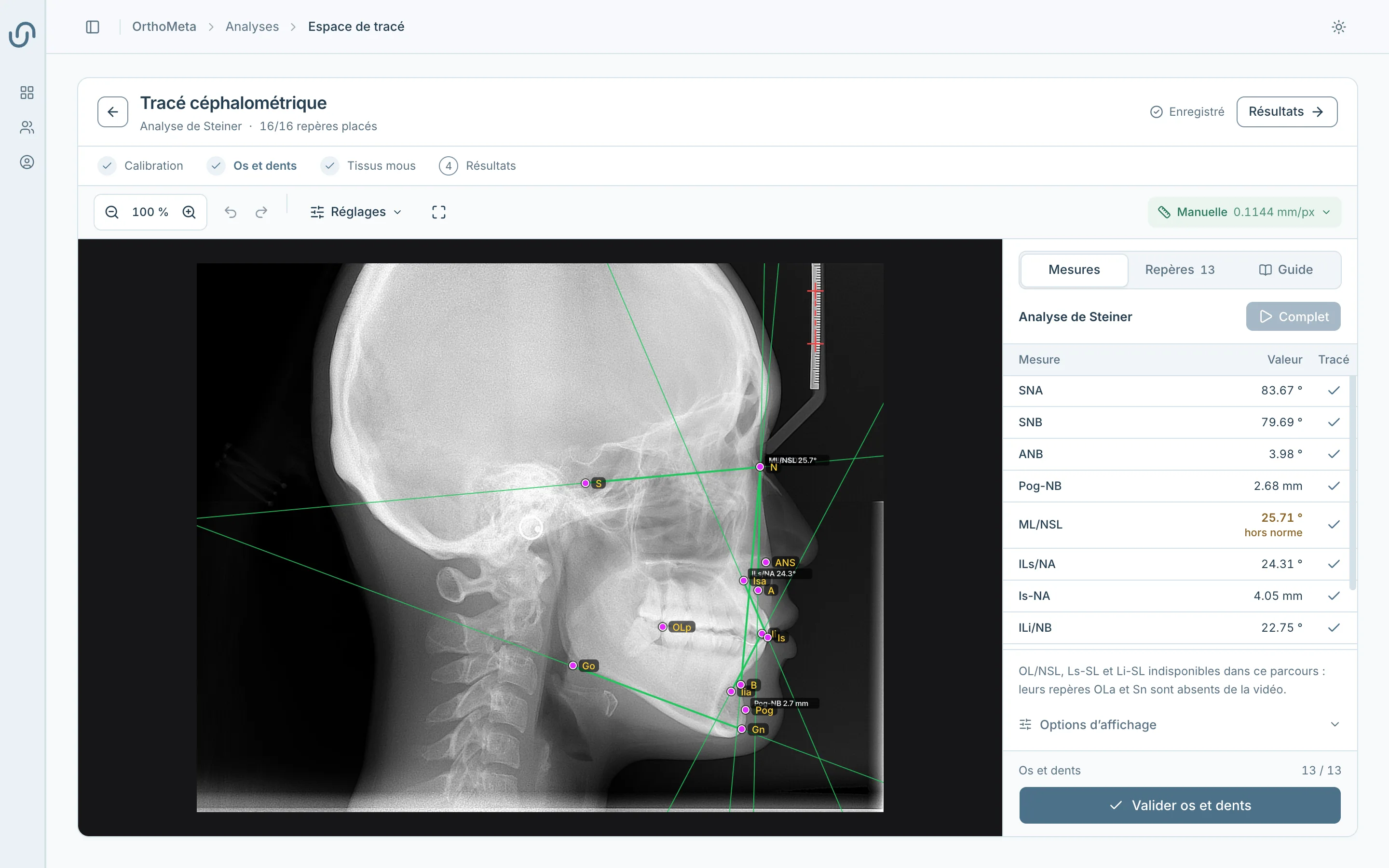 Visionneuse céphalométrique : repères placés sur une téléradiographie de profil, guide anatomique affiché à côté.
